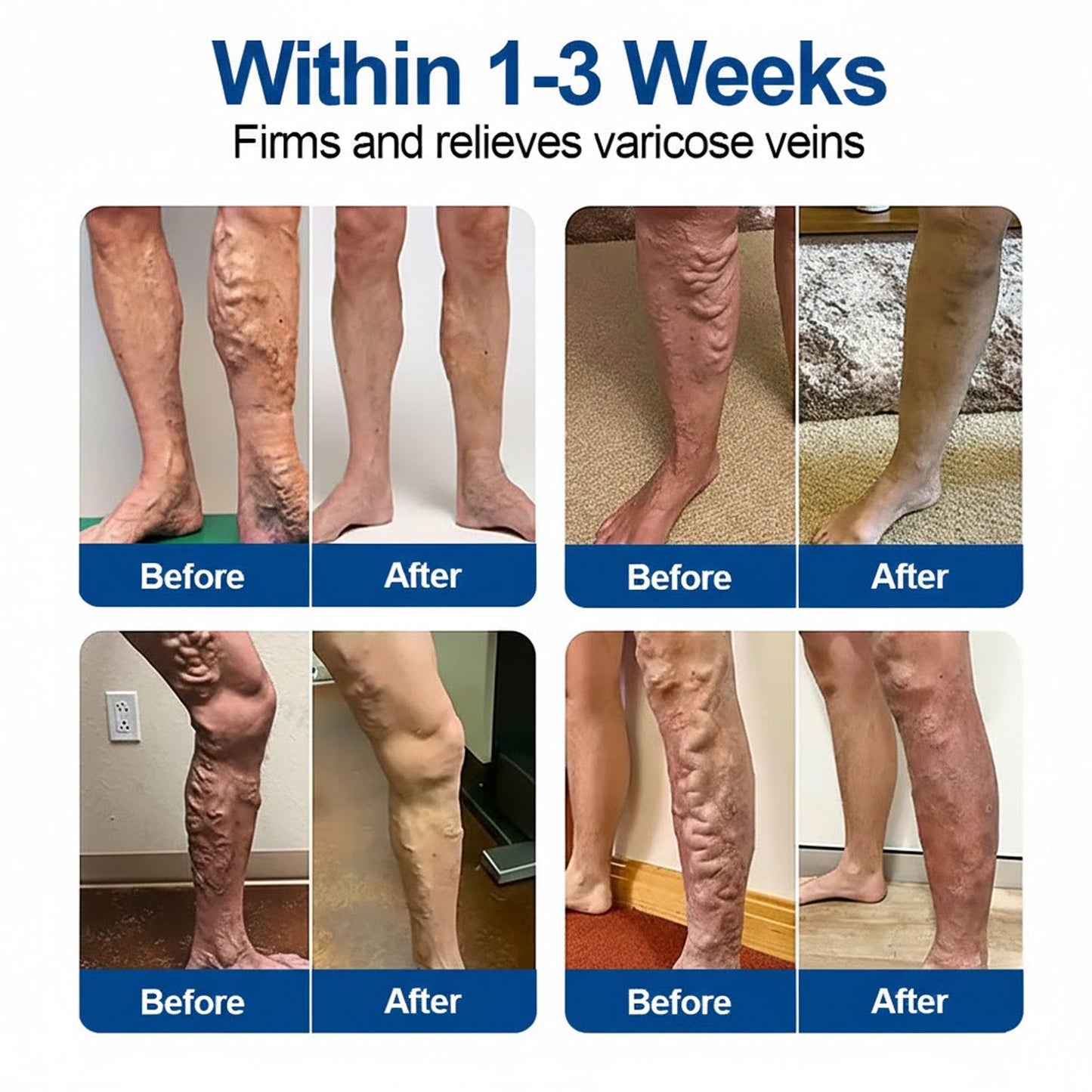 🇺🇸👨‍⚕️ VeinEase Microneedle Care Patch⚡Instant Relief, Long-Term Results