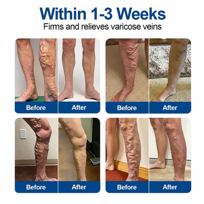 🇺🇸👨‍⚕️ VeinEase Microneedle Care Patch⚡Instant Relief, Long-Term Results
