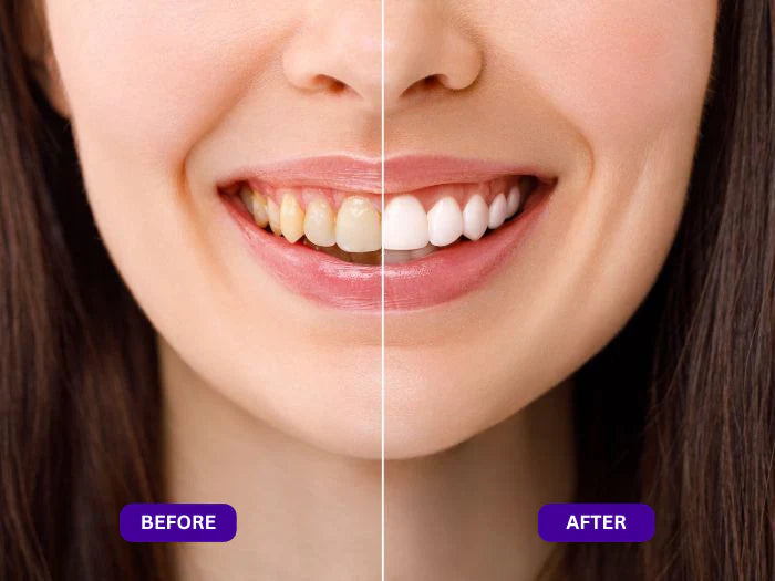 Purple Teeth Whitening Strips | Fast, Gentle & Peroxide-Free Whitening