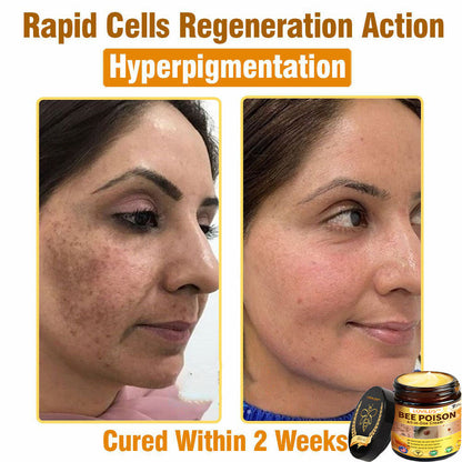 LOVILDS™ Bee Poison All-in-One Cream US Dermatologist Approved