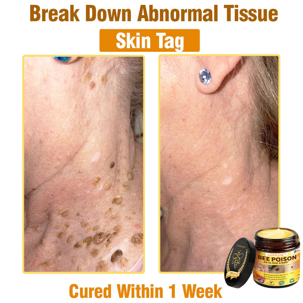 LOVILDS™ Bee Poison All-in-One Cream US Dermatologist Approved